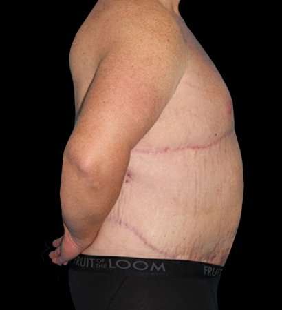Massive Weight Loss Before & After Patient #5155