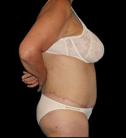 Circumferential Body Lift Before & After Patient #2572