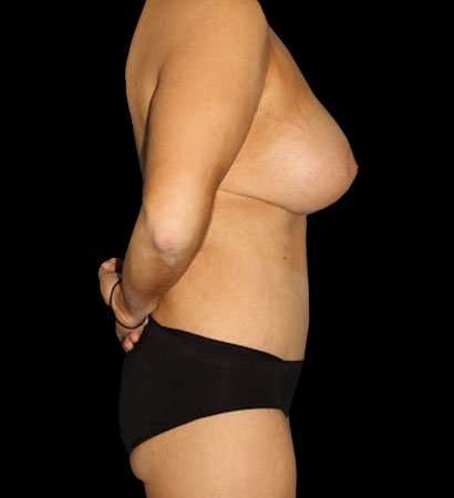 Circumferential Body Lift Before & After Patient #2585