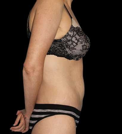 Circumferential Body Lift Before & After Patient #2598