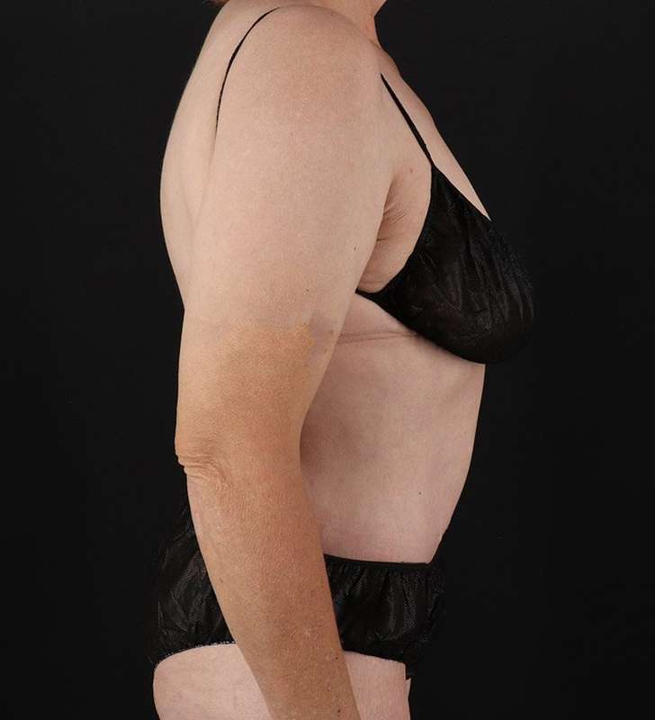 Circumferential Body Lift Before & After Patient #2624