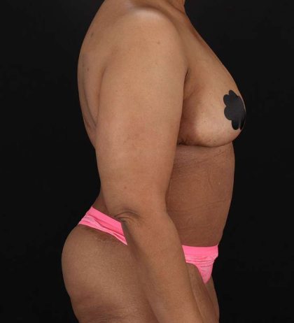 Circumferential Body Lift Before & After Patient #2637