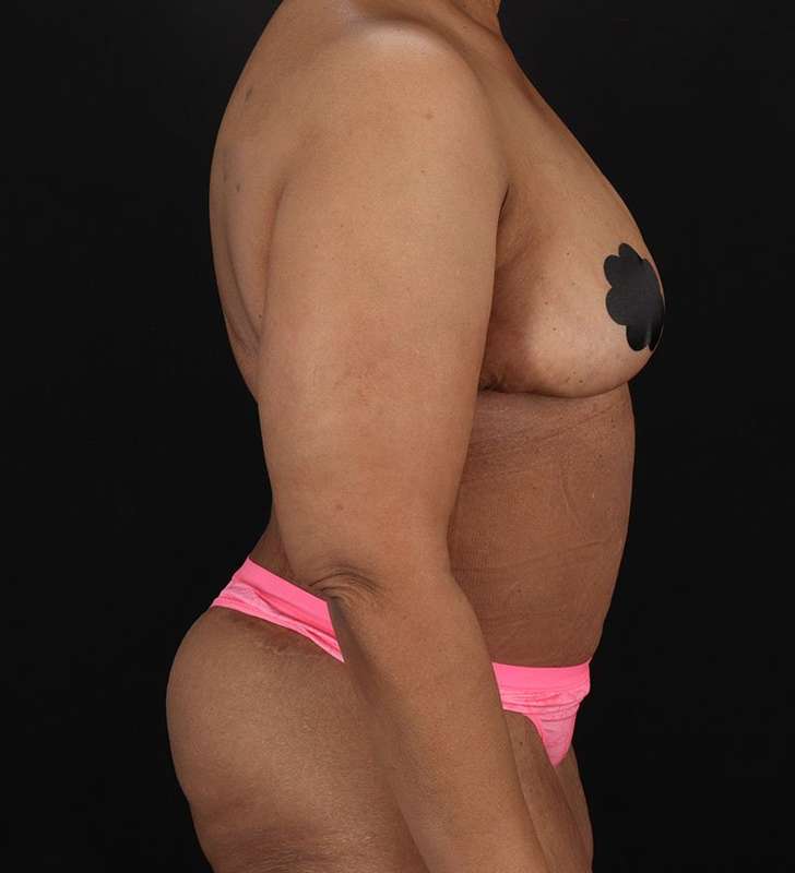 Circumferential Body Lift Before & After Patient #2637