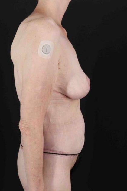 Circumferential Body Lift Before & After Patient #2663