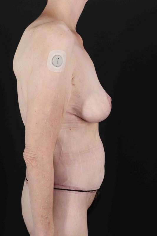 Circumferential Body Lift Before & After Patient #2663