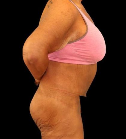 Fleur De Lis Circumferential Body Lift Before & After Patient #2674