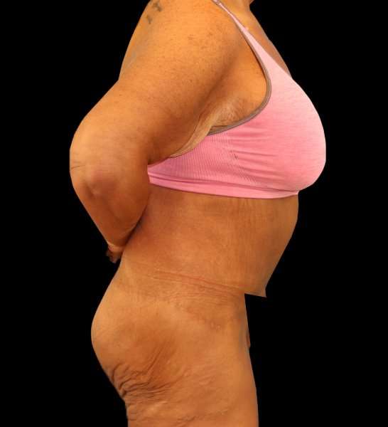 Fleur De Lis Circumferential Body Lift Before & After Patient #2674