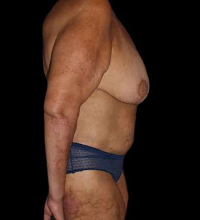 Fleur De Lis Circumferential Body Lift Before & After Patient #2685