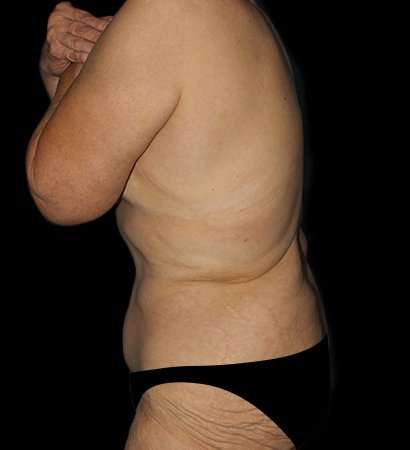 Fleur De Lis Tummy Tuck Before & After Patient #2692