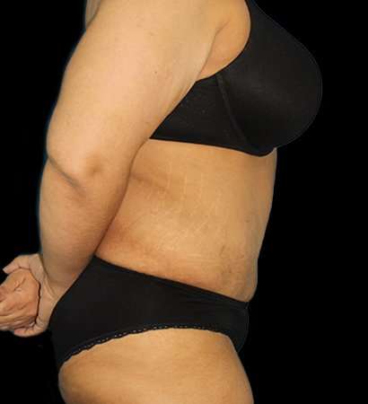 Fleur De Lis Tummy Tuck Before & After Patient #2703