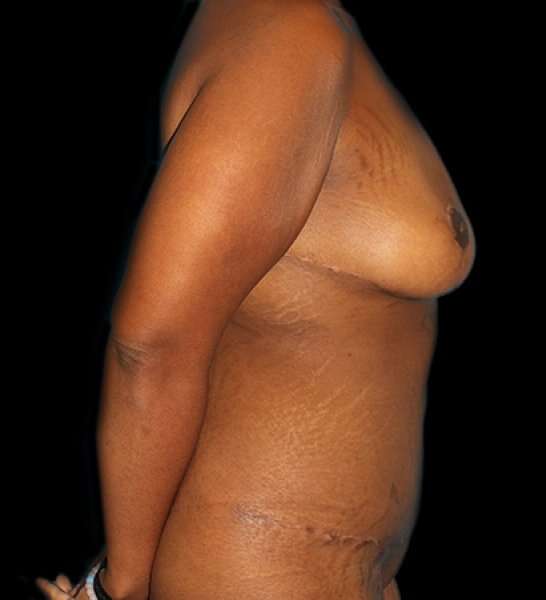 Fleur De Lis Tummy Tuck Before & After Patient #2714