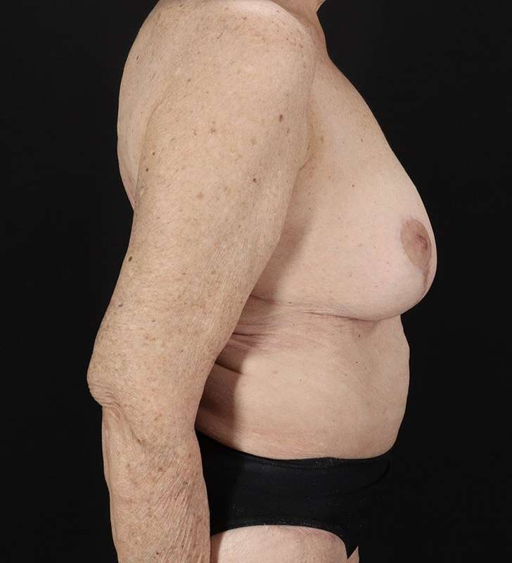 Fleur De Lis Tummy Tuck Before & After Patient #2727