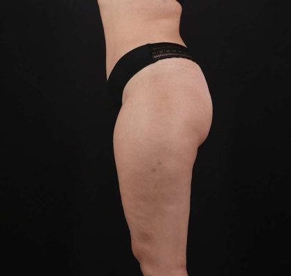 Liposuction Before & After Patient #2736