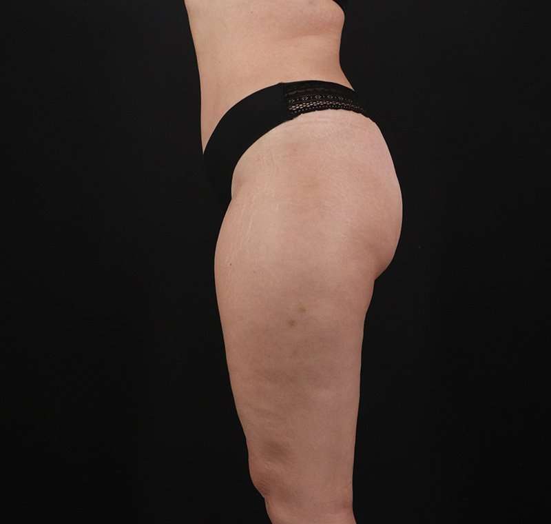 Liposuction Before & After Patient #2736