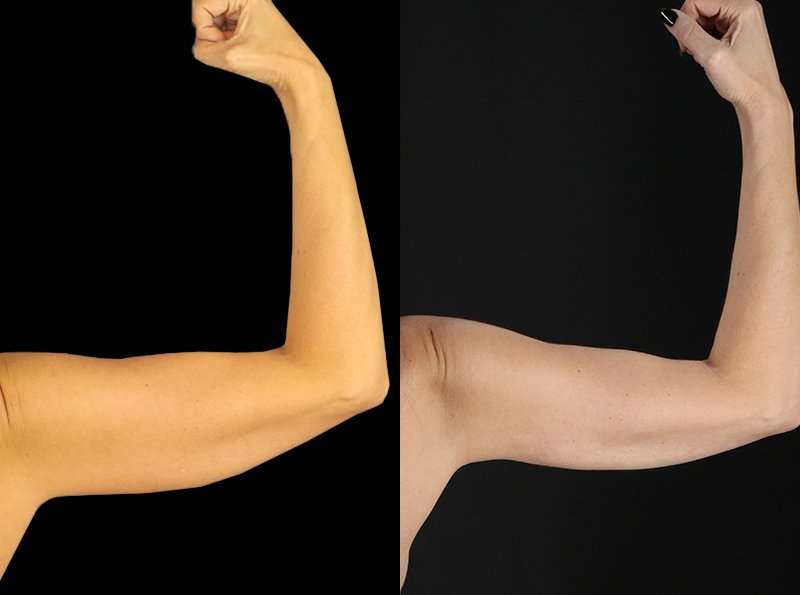 Liposuction Before & After Patient #2743