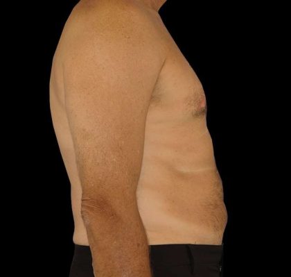 Liposuction Before & After Patient #2756