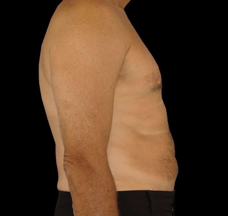Liposuction Before & After Patient #2756