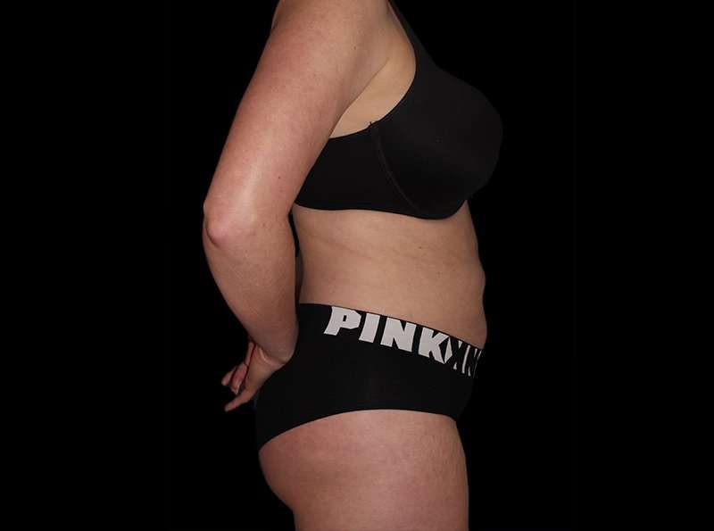 Liposuction Before & After Patient #2778