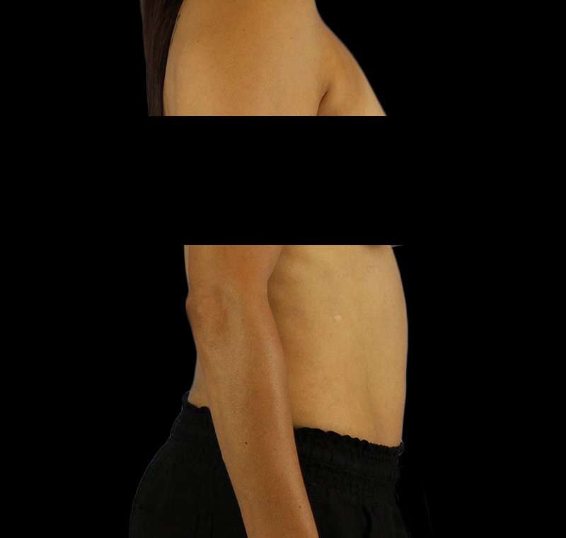 Liposuction Before & After Patient #2811