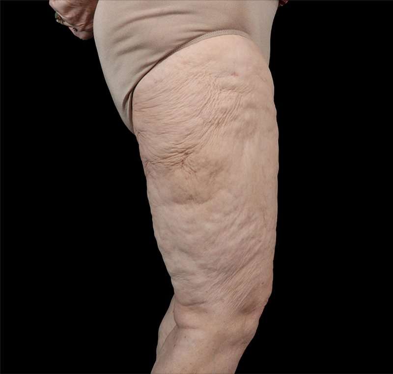 Liposuction Before & After Patient #2829