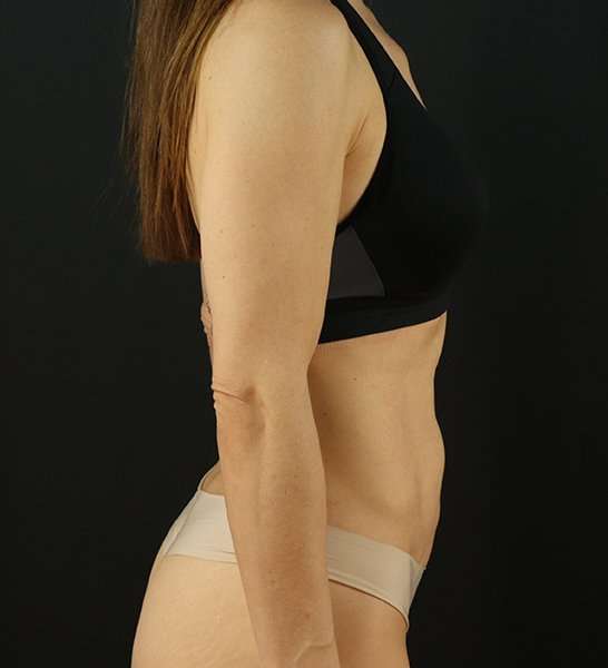 Mini Tummy Tuck Before & After Patient #2856