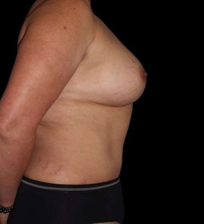 Mommy Makeover Before & After Patient #2878