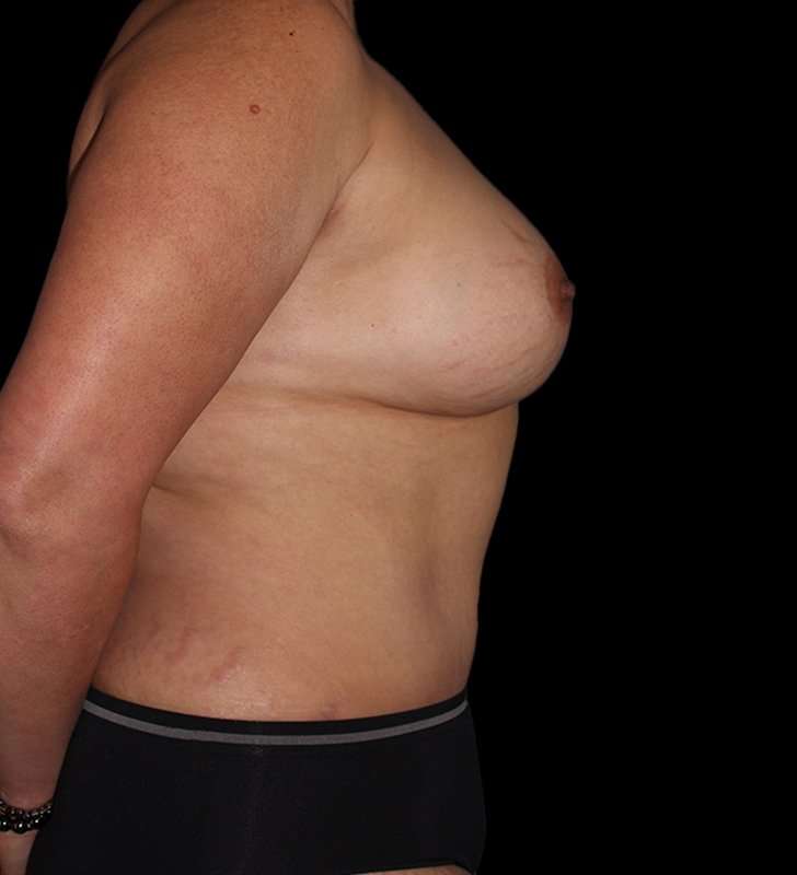 Mommy Makeover Before & After Patient #2878