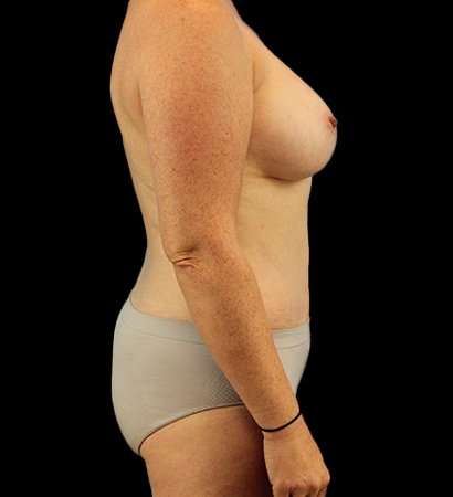 Mommy Makeover Before & After Patient #2974