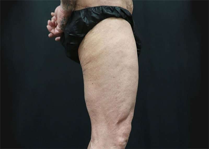 Thigh Lift Before & After Patient #2992