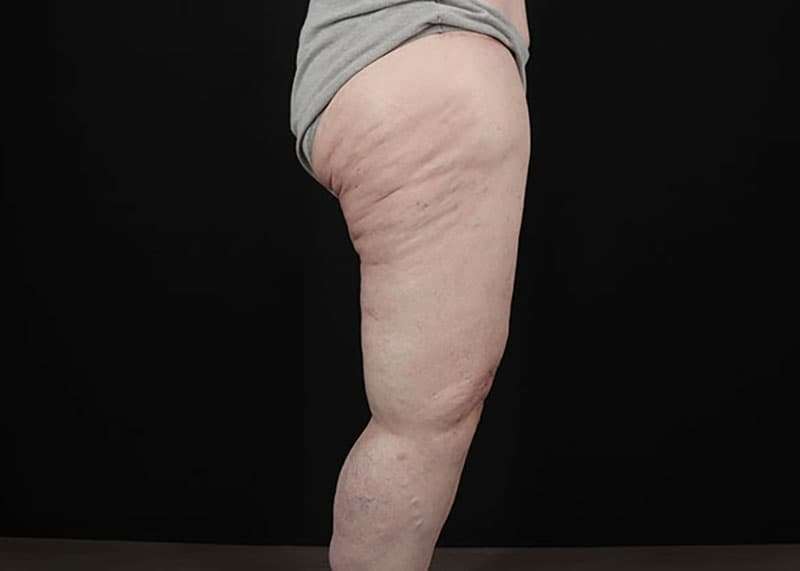 Thigh Lift Before & After Patient #3005