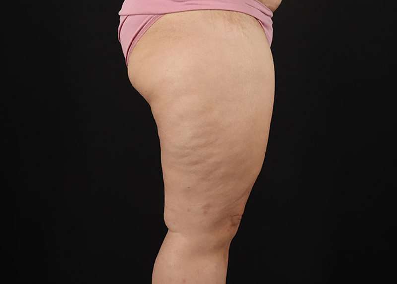 Thigh Lift Before & After Patient #3018