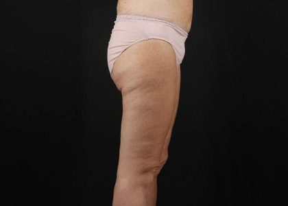 Thigh Lift Before & After Patient #3031