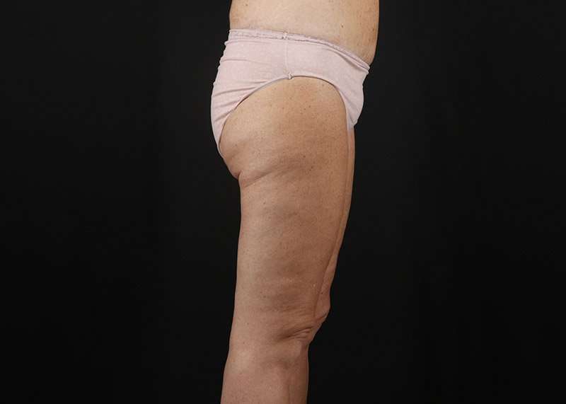 Thigh Lift Before & After Patient #3031