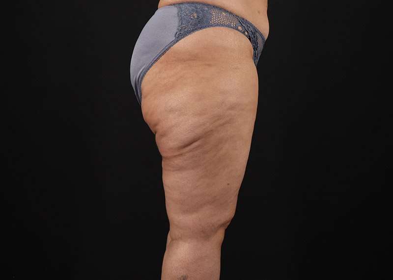 Thigh Lift Before & After Patient #3044