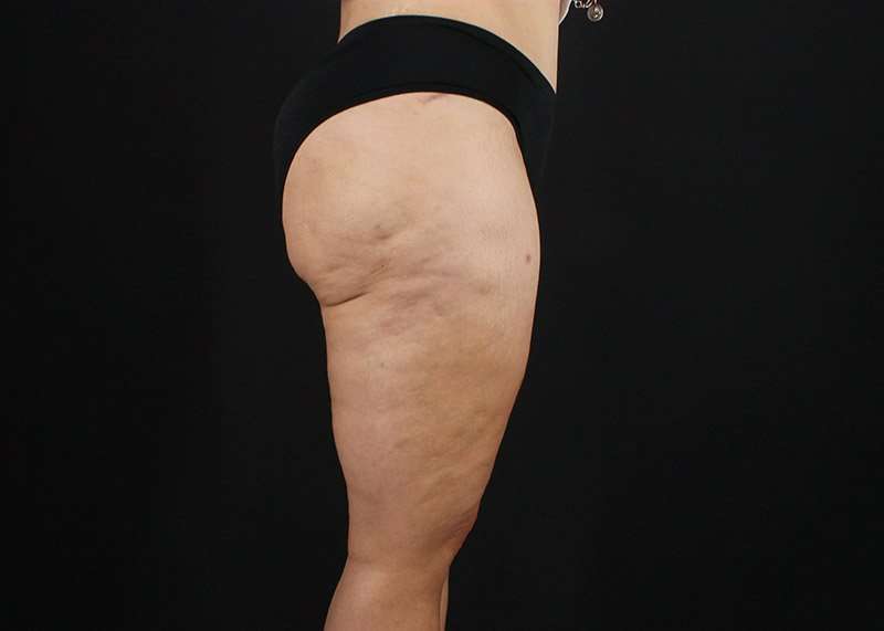 Thigh Lift Before & After Patient #3057