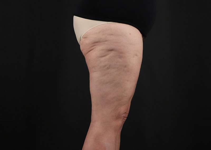 Thigh Lift Before & After Patient #3070