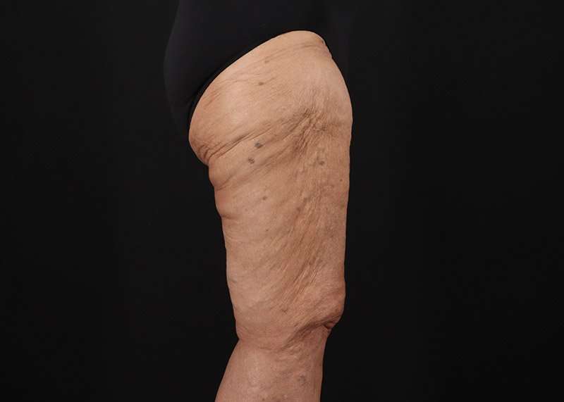 Thigh Lift Before & After Patient #3083