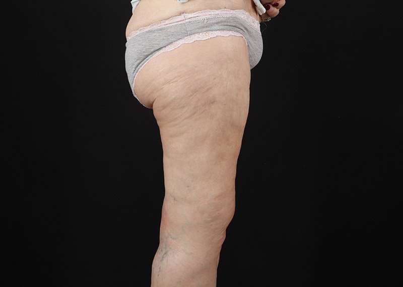 Thigh Lift Before & After Patient #3096