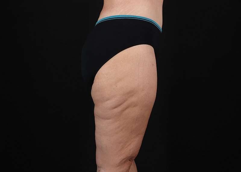 Thigh Lift Before & After Patient #3109