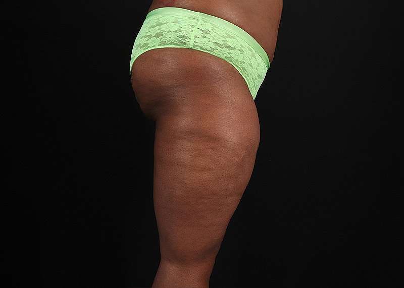 Thigh Lift Before & After Patient #3122