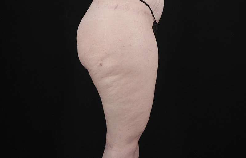 Thigh Lift Before & After Patient #3135