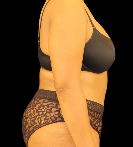 Tummy Tuck Revision Before & After Patient #3146