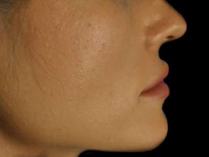Lip Augmentation - Fat Grafting Before & After Patient #3210