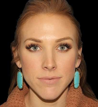Botox Before & After Patient #3217