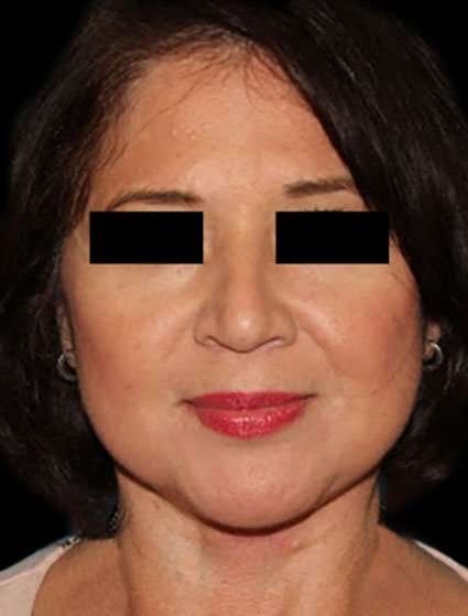 Face & Neck Lift Before & After Patient #3248