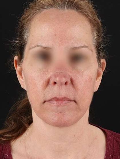 Face & Neck Lift Before & After Patient #3270