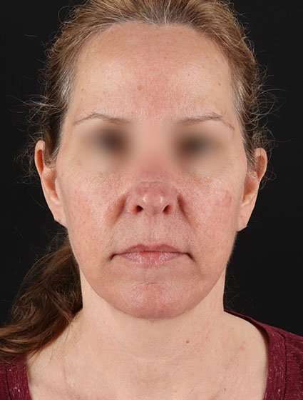 Face & Neck Lift Before & After Patient #3270