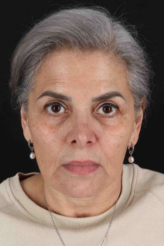 Face & Neck Lift Before & After Patient #3292