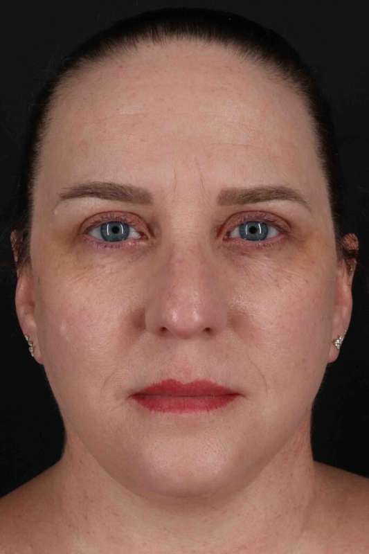 Face & Neck Lift Before & After Patient #3303