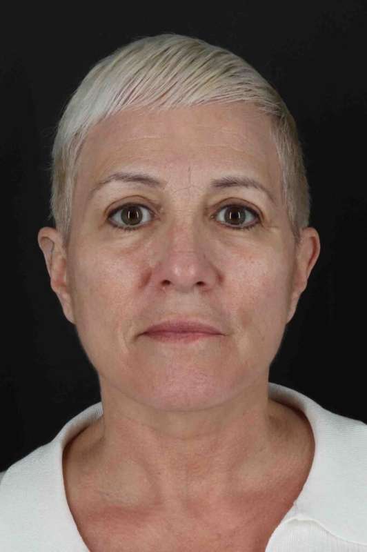 Face & Neck Lift Before & After Patient #3314